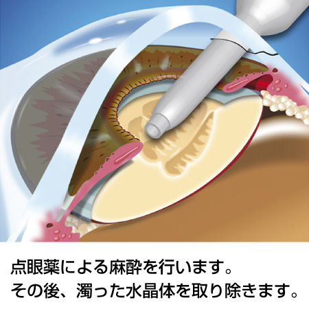 白内障手術の流れ