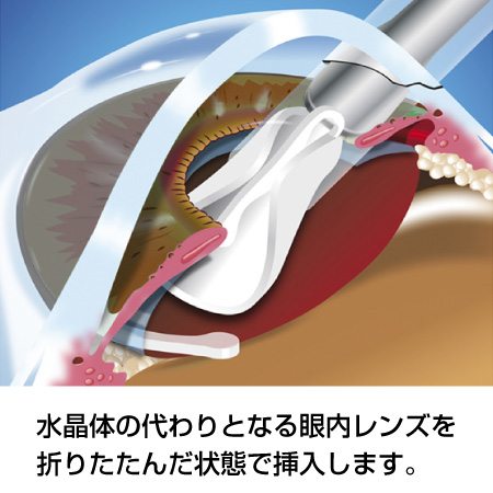 白内障手術の流れ