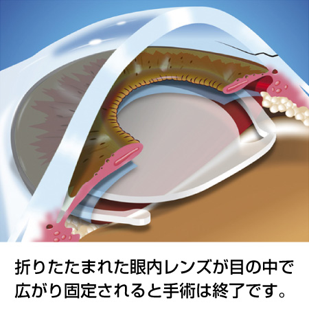 白内障手術の流れ